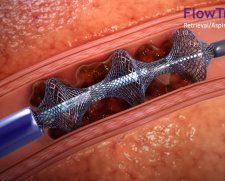 Inari Medical Inari Flowtriever | Used in Thrombectomy  | Which Medical Device